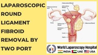 Minimally Invasive Surgery: Laparoscopic Round Ligament Fibroid Removal by Two-Port Technique