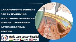 Laparoscopic Resection of a Torted Ovarian Dermoid Cyst