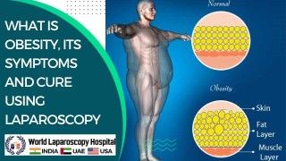 Laparoscopic Myomectomy and Salpingo-oophorectomy with Palmer's Point and Extraction by Colpotomy