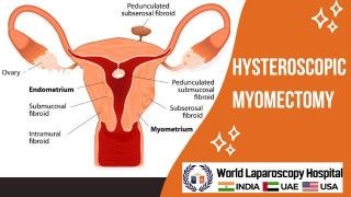 Hysteroscopic Myomectomy: A Minimally Invasive Solution for Uterine Fibroids