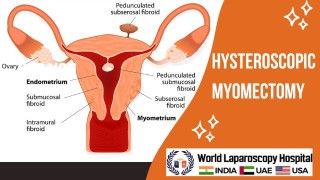 Bilateral Dermoid Cyst