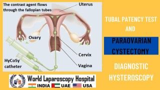 Bilateral Dermoid Cyst