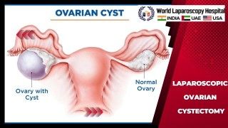 Laparoscopic Myomectomy HD Video for Multiple Myoma using Mishra's Knot