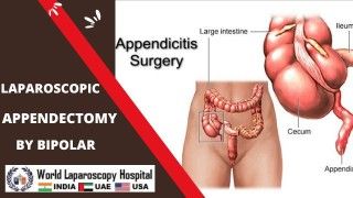 Laparoscopic Fundoplication Lecture by Dr R K Mishra