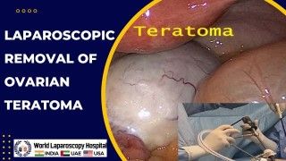 Laparoscopic Precision Unveiled: Ovarian Teratoma Removal with Minimally Invasive Expertise