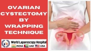 Revolutionary Approach: Ovarian Cystectomy by Wrapping Technique Unveiled