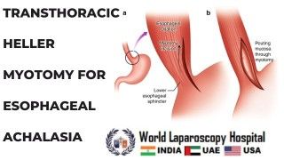 TAPP Inguinal Hernia Repair by Ipsilateral Port