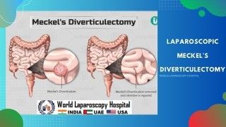Laparoscopic Myomectomy for Multiple Myoma