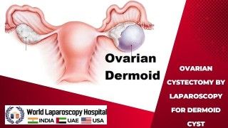 Laparoscopic Ovarian Cystectomy: Minimally Invasive Removal of Dermoid Cysts