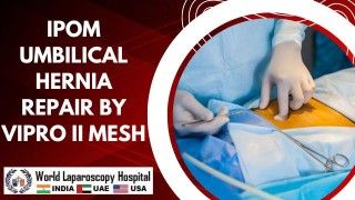 Revolutionizing Umbilical Hernia Repair: Enhanced IPOM Technique with VIPRO II Mesh