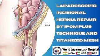 Laparoscopic Myomectomy Lecture by Dr R K Mishra