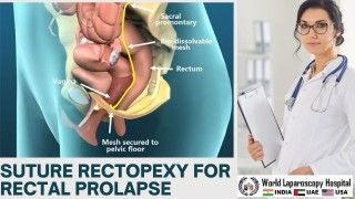 Restoring Stability: Suture Rectopexy Offers Effective Treatment for Rectal Prolapse