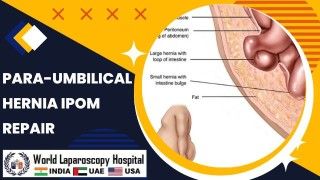 Effective Treatment for Para-umbilical Hernia: IPOM Repair with Minimally Invasive Approach