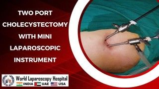 Two Port Cholecystectomy with Mini Laparoscopic Instruments for Gallbladder Removal