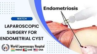 Laparoscopic Management of Perforated Appendicitis