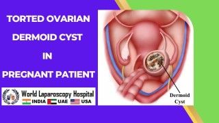 Revolutionizing Gynecological Surgery: Robotic Bilateral Ovarian Cystectomy offers precision
