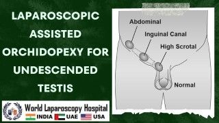 Laparoscopic Assisted Orchiopexy for Undescended Testes: Dr. R K Mishra's Demonstration
