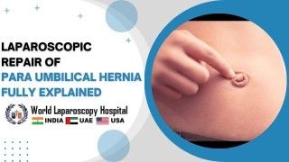 Laparoscopic Repair of Para Umbilical Hernia, fully explained for effective treatment