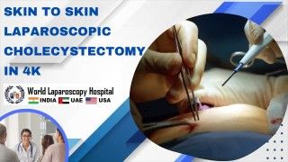 4K Skin to Skin Cholecystectomy: Precision and minimal scarring in gallbladder removal