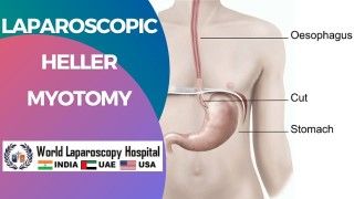 Laparoscopic Ventral Hernia repair by Dr R K Mishra