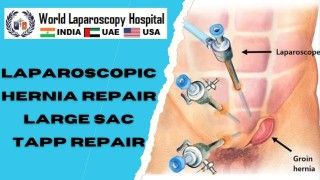 Advanced Precision: Laparoscopic Hernia Repair with Large Sac TAPP Technique