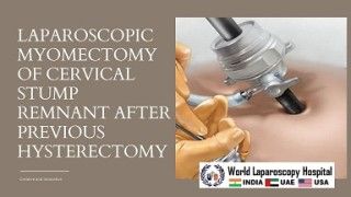 Laparoscopic myomectomy of cervical stump remnants after a previous hysterectomy