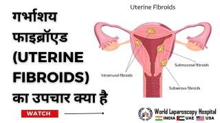 गर्भाशय फाइब्रॉएड (Uterine Fibroid) का उपचार: जानें इसके विभिन्न चिकित्सा प्रकार