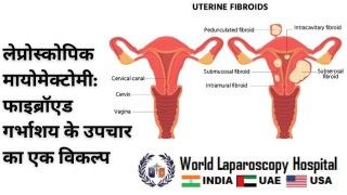 Laparoscopic Removal of Large Posterior Cervical Fibroid