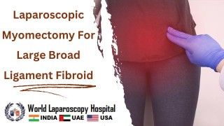 Surgical Precision Unleashed: Laparoscopic Myomectomy for Large Broad Ligament Fibroid