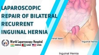 Successfully addressing both sides of recurrent inguinal hernias through laparoscopic repair