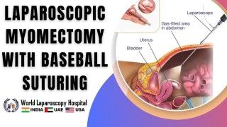 Exploring laparoscopic myomectomy baseball suturing for optimal results