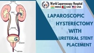 Bilateral Laparoscopic Inguinal Hernia Surgery