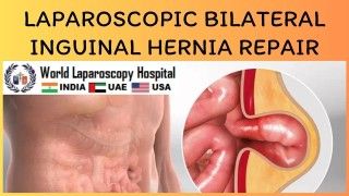 Laparoscopic Bilateral Inguinal Hernia Repair Offers Minimally Invasive Solution