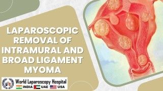 Minimally Invasive Triumph: Laparoscopic Removal of Intramural and Broad Ligament Myoma