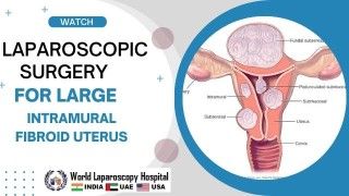 Advantage and Disadvantages of Laparoscopic Surgery