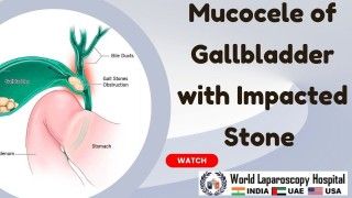 Mishra's Knot: Effective Surgery for Gallbladder Mucocele with Impacted Neck Stone