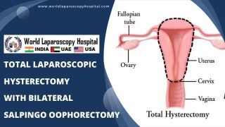 Safest Total Laparoscopic Hysterectomy with Bilateral Salpingo-oophorectomy