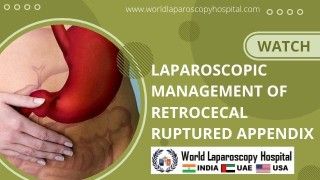Advancing Minimally Invasive Surgery: Laparoscopic Management of Retrocecal Ruptured Appendix