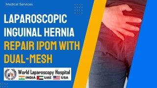 Innovative Approach: Laparoscopic Inguinal Hernia Repair IPOM with Dual-Mesh