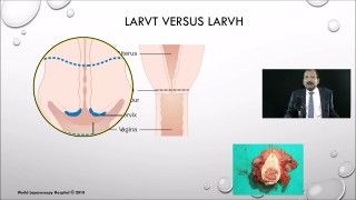 Laparoscopic Radical Hysterectomy