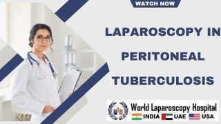 Laparoscopic management of Peritoneal Inclusion Cyst