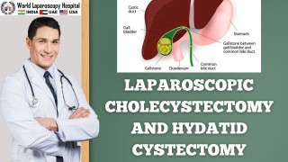 Surgical Advances: Laparoscopic Cholecystectomy and Hydatid Cystectomy