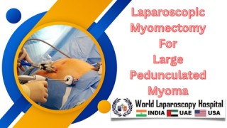 Expertise in Action: Performing Laparoscopic Myomectomy on a Substantial Pedunculated Myoma