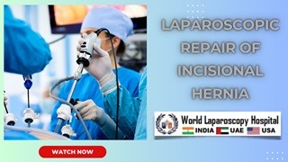 Mastering Laparoscopic Technique: Recurrent Incisional Hernia Repair by Laparoscopy Simplified