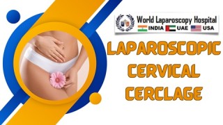 How to Perform Laparoscopic Cervical Cerclage: A Step-by-Step Guide