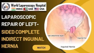 Visual Guide: Laparoscopic Repair of Left-Sided Complete Indirect Inguinal Hernia