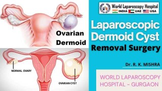 Ovarian cystectomy for Right Ovarian Cyst