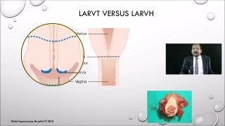 Laparoscopic Myomectomy with Tubal Ligation by Falope Ring