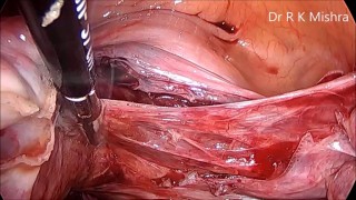Laparoscopic Myomectomy for Intramural Fibroid