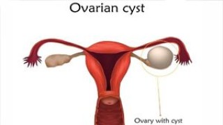 Transvaginal Ovary Extraction via Laparoscopic Salpingo-Oophorectomy